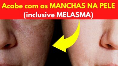 Acabe com as manchas na pele, inclusive melasma