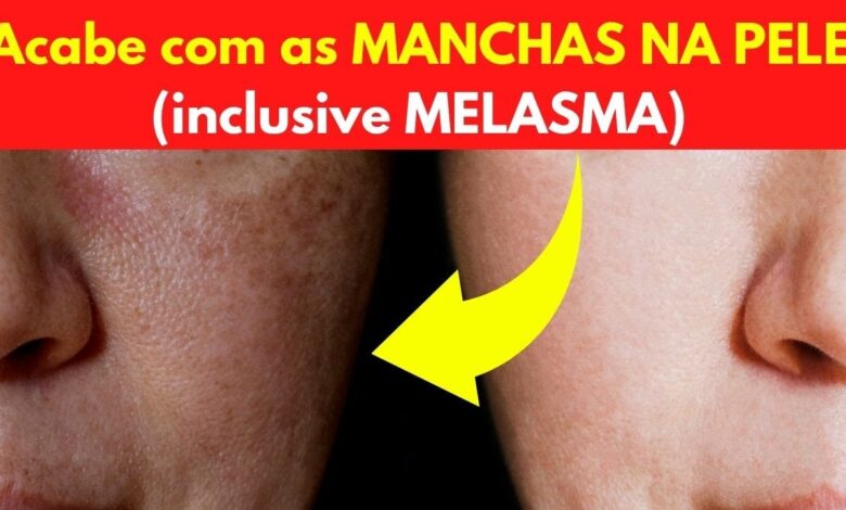 Acabe com as manchas na pele, inclusive melasma