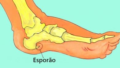 Tratamento caseiro para esporão de calcâneo utilizando um ingrediente