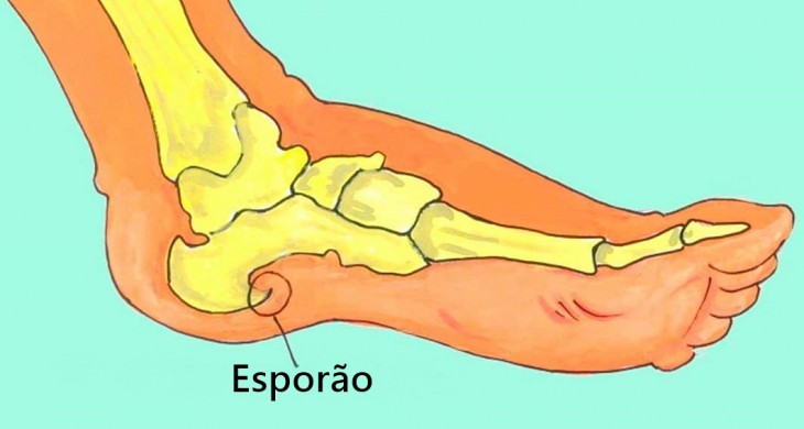 Tratamento caseiro para esporão de calcâneo utilizando um ingrediente